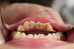 Видове Dental Implants 13