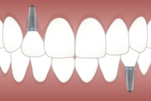 Вижте Dental Implants 18