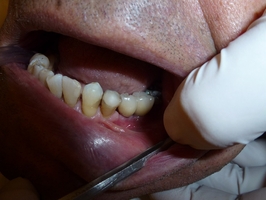 Вижте Dental Implants 37