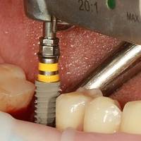 Повече за  Dental Implants Bulgaria 2