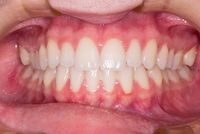 Ефектни фасети цени 10 от MedicalDent Ефектни фасети цени 10