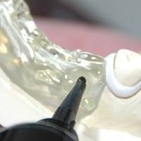 Видове пародонтит 19 от MedicalDent Видове пародонтит 19