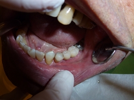 Information about Dental Implants 10