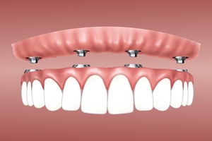 Best offer for Dental Implants 33