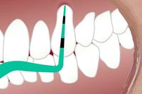Invisalign - 54140 бестселъри