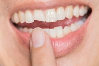 Invisalign - 71161 варианти