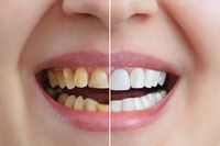 инвизалайн - 38272 клиенти