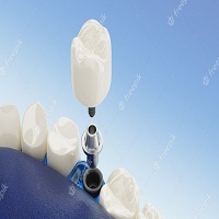 циркониева коронка цена - 69708 бестселъри