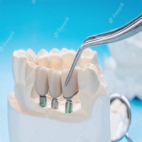 циркониева коронка цена - 81167 бестселъри