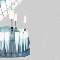възстановяване след поставяне на зъбни импланти - 73496 селекции