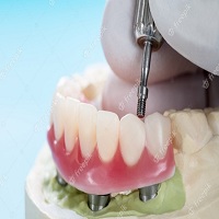 зъбни импланти - 86954 клиенти зъбни импланти - 52853 клиенти