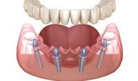 бондинг Варна - 5475 предложения | Dental Club бондинг Варна - 60972 предложения