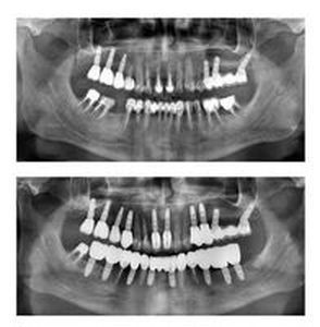 бруксизъм - 3036 типа | Supreme Dental бруксизъм - 19404 типа