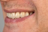 изтрити зъби - 28924 селекции | Supreme Dental изтрити зъби - 29590 селекции